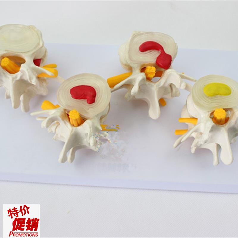 人体四阶段病态正常q腰椎比较病变骨骼标本模具病理模型