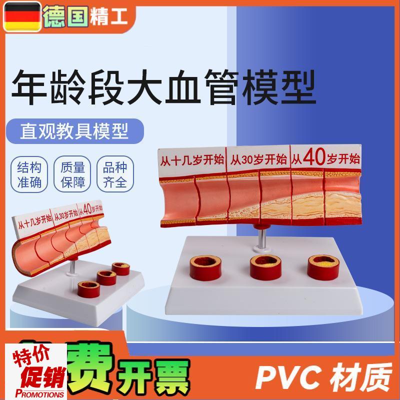 德国】年龄段大血管模型4部件/硬化心血管动脉S/硬化模型血管病