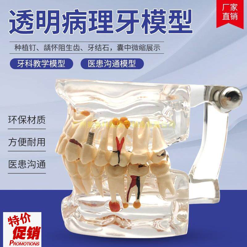 牙齿模型自然大透o明牙体病理模型口腔科病理模型医患模型