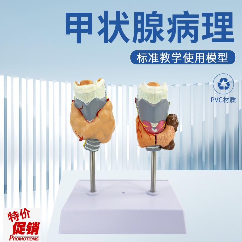 教学仿真人体甲状腺病理模型甲亢模型病态甲状腺模型.甲状腺结节