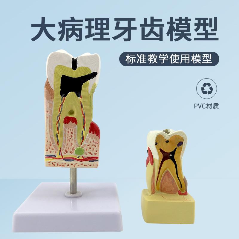 人体病态蛀牙g模牙齿牙结构解剖蛀牙模型牙齿病综合病理模型