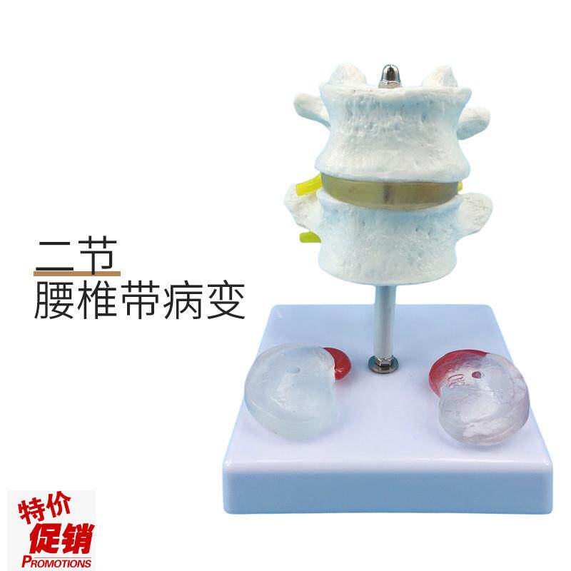 人体腰椎模型二节腰椎带病变椎C间盘模型椎间盘病变脊柱骨演示