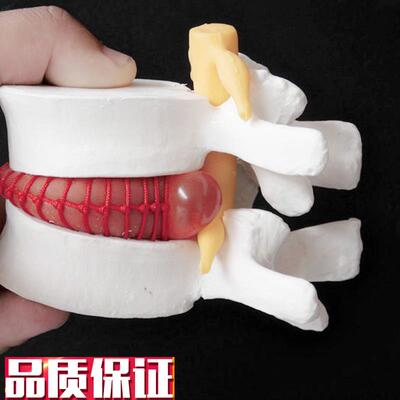 人体腰椎间盘膨出演示模型腰椎模型人体脊柱X模型脊椎模型
