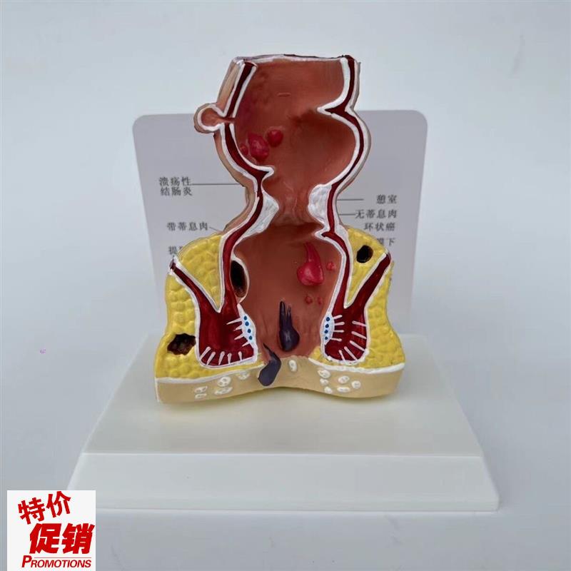 人体直肠模型肛管裂开痔s内外突出瘘管消化道结肠大肠医患病理沟