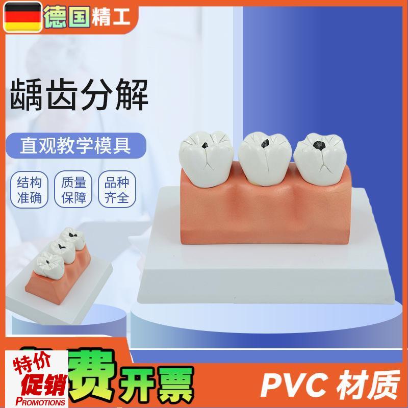 德国】龋齿病分解解剖模型牙齿模型口腔牙N保健护理模型牙科牙齿