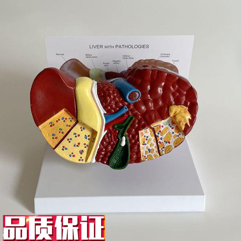 康泰模型肝脏脂肪肝叶韧带门静z脉胆囊肝总管病理酒精消化道医药