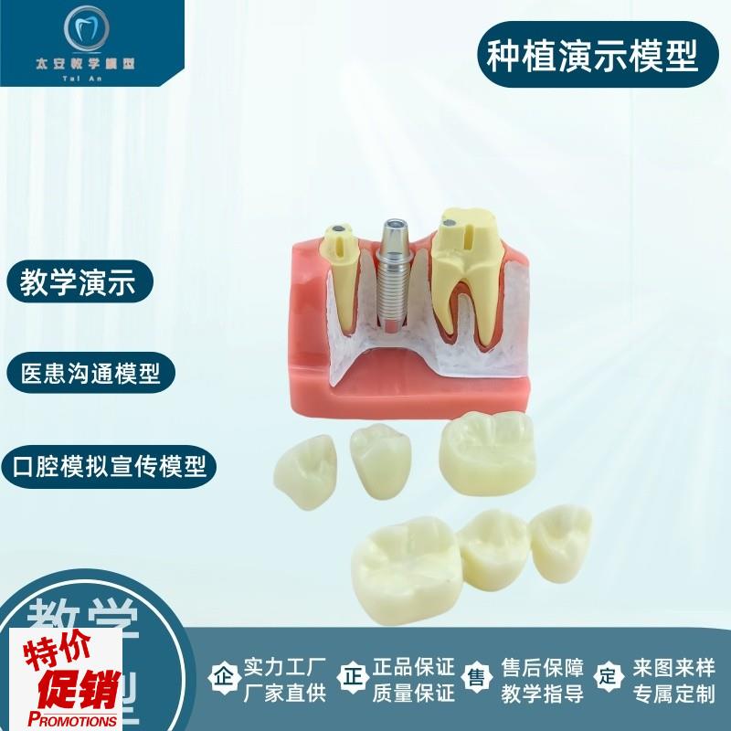 牙科口腔种植模型演r示模型医患沟通教学练习种植牙模型