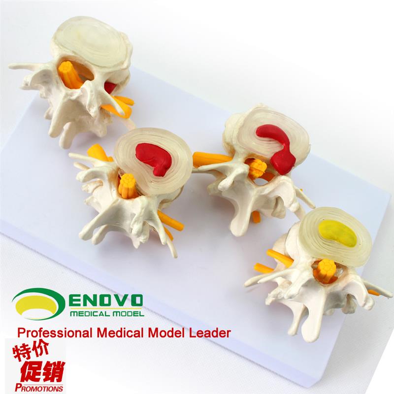 ENOVO颐诺医学人体腰椎模型椎体椎间盘病变髓T核膨出脱出软骨板