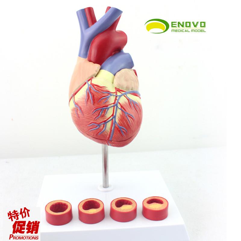 ENOVO颐诺1:1医学人体心x脏模型冠状动脉血栓心内科教学动脉粥样