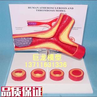 人体解剖模型 人体支脉粥样g硬化和血栓管形成模型人体模型