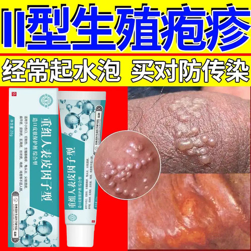 北京同仁堂生殖器疱疹感染男女防复发膏