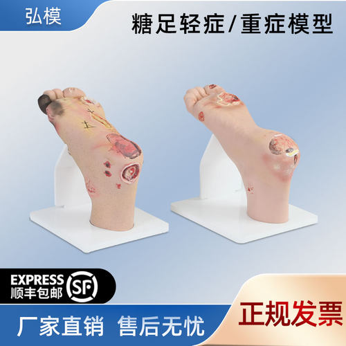 糖尿病足护理模型弘模老年人畸形