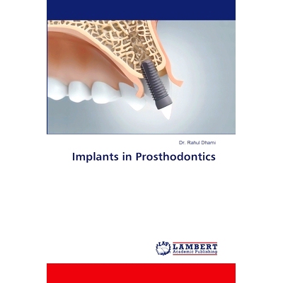 预订 Implants in Prosthodontics: 9786207640522