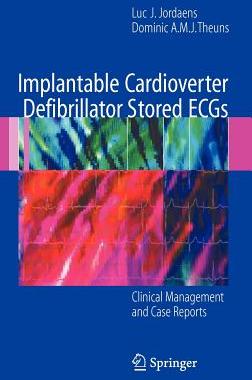 【预订】Implantable Cardioverter Defibrillator Stored ECGs