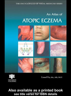 【预订】An Atlas of Atopic Eczema