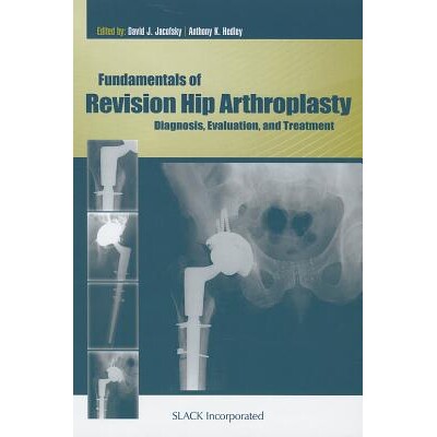 预订 Fundamentals of Revision Hip Arthroplasty Diagnosis, Evaluation, and Treatment 髋关节置换术基础:诊断、评估和治疗 9