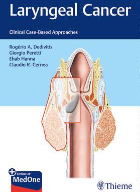 [预订]Laryngeal Cancer 9781684200016