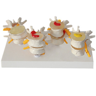 医用人体腰椎变模型骨质疏松椎间盘突出老年骨质骨科疼痛科疾病