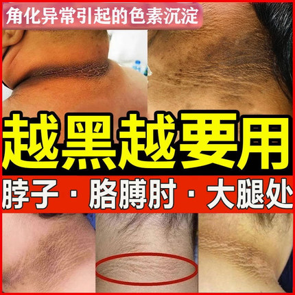 脖子黑色素去除黑棘皮症脖子黑色素沉淀洗不干净肥胖儿童美白神器