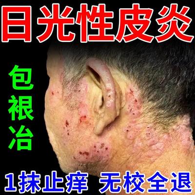 日光性皮炎太阳晒伤紫外线过敏跟止痒抑菌去皮肤瘙痒外用修复膏