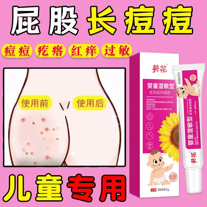 宝宝儿童身上起疙瘩过敏小孩屁股上长痘痘痒皮肤长小红点热疹瘙痒