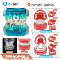 牙科自锁托槽 正畸牙模型 陶瓷托槽 金属托槽 自锁托槽对比模型