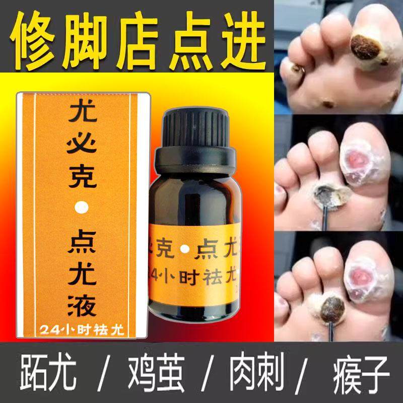 点疣液24小时袪除跖疣趾疣甲周疣