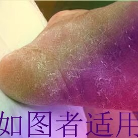 浸泡粉剂疗程装脚干裂