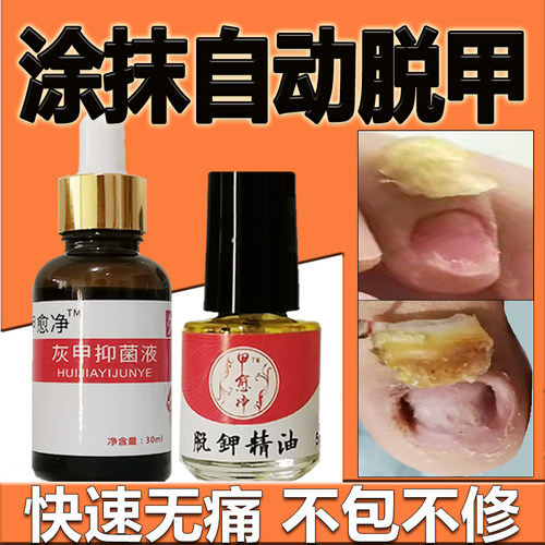 【快速脱灰指甲】独家配方
