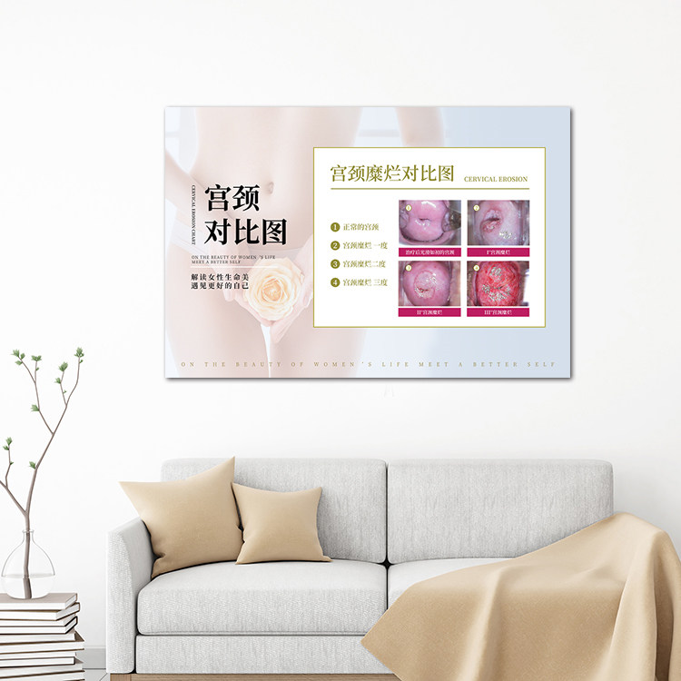 宫颈对比图挂画 医美整形美容医院墙装饰画女性妇科诊所无框壁画