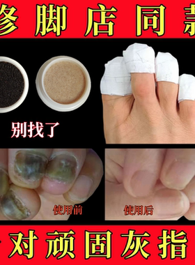 灰指甲专用液修脚店同款