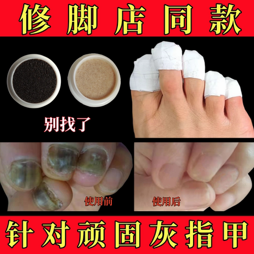 灰指甲专用液修脚店同款