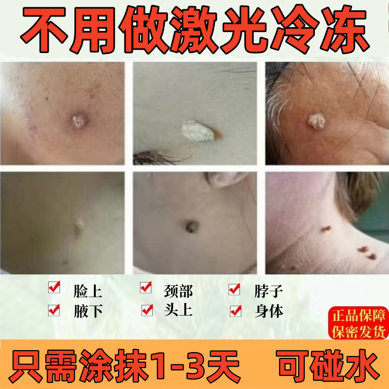 丝状疣小肉粒只需涂抹1-3天