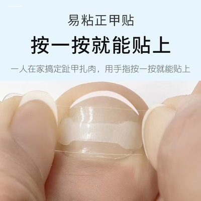 甲沟矫正器指甲矫正嵌甲神器纠正器脚趾甲贴片卷曲甲专用正甲扣炎
