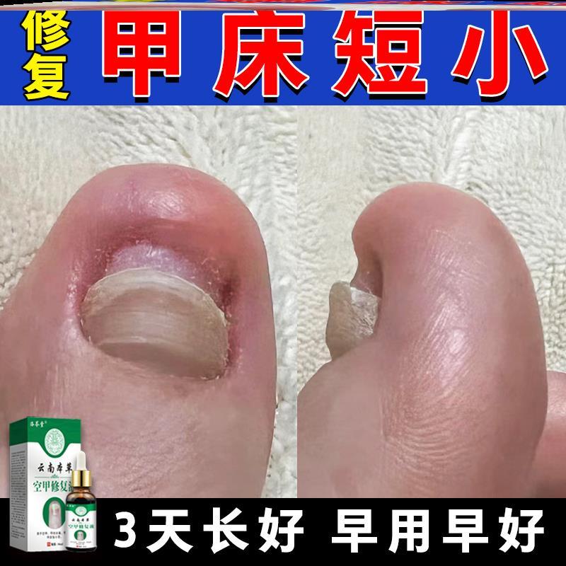 甲床短小修复生长液甲床分离肉包甲指甲增厚长不出来易断裂修复液