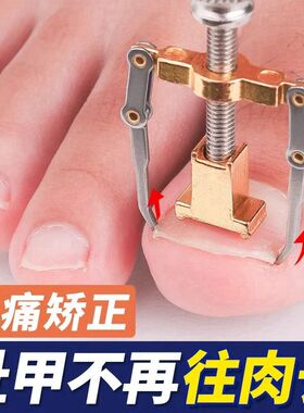 甲沟矫正神器嵌甲卷甲纠正器甲脚趾甲变形往肉里长专用正甲神器炎