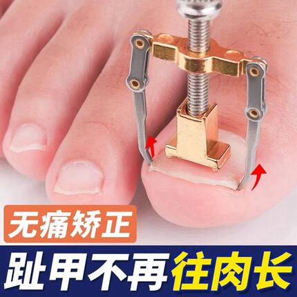 甲沟矫正神器嵌甲卷甲纠正器甲脚趾甲变形往肉里长专用正甲神器炎
