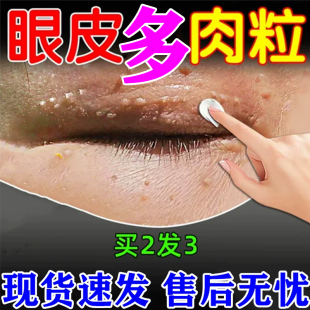 眼睛丝眼皮脖子上长小肉粒状去除尤瘊药膏神器鸭胆子祛眼周角眶