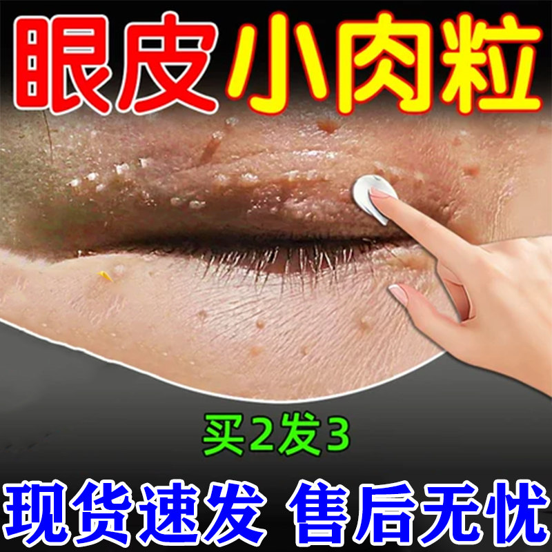 眼睛丝眼皮脖子上长小肉粒状去除尤瘊药膏神器鸭胆子祛眼周角眶