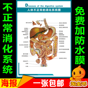 人体不正常的消化系统示意图 内脏结构图人体解剖图医院宣传挂图