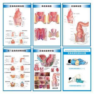 肛肠常见痔疮疾病图例宣传海报
