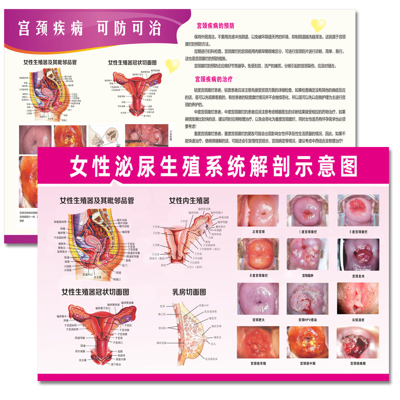 医院妇科宫颈疾病示意图挂图海报子宫女性生殖器系统解剖图宣传画