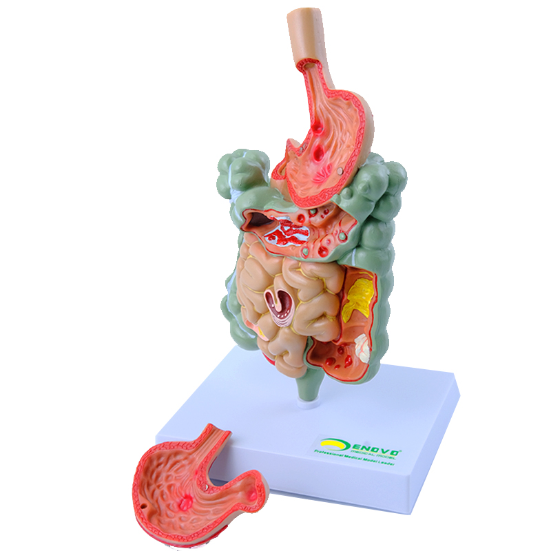 ENOVO颐诺 人体胃肠部疾病演示模型 消化内科胃病肠道疾病展示医