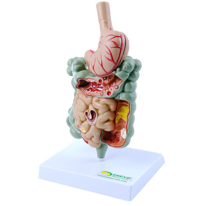 enovo颐诺 人体胃肠部疾病演示模型 消化内科胃病肠道疾病展示医