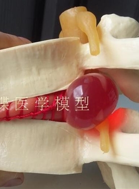 Lumbar disc herniation Human anatomy skeleton Spine model Te