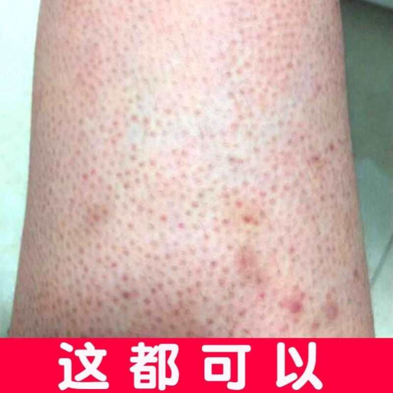 去鸡皮肤疙瘩毛囊角质毛周角化果酸手臂大小腿红点黑点维a软膏治