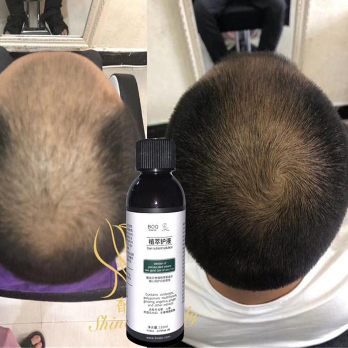 boq毛发营养液植萃护生发液发际线防脱发增发密发快速头发增长液
