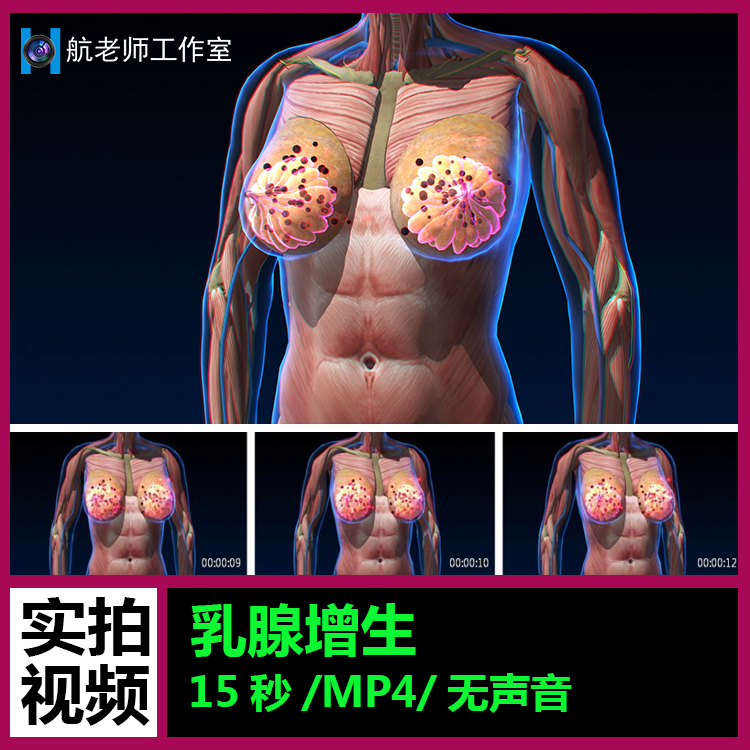 乳房疾病乳腺增生女性健康 3D动画渲染视频素材