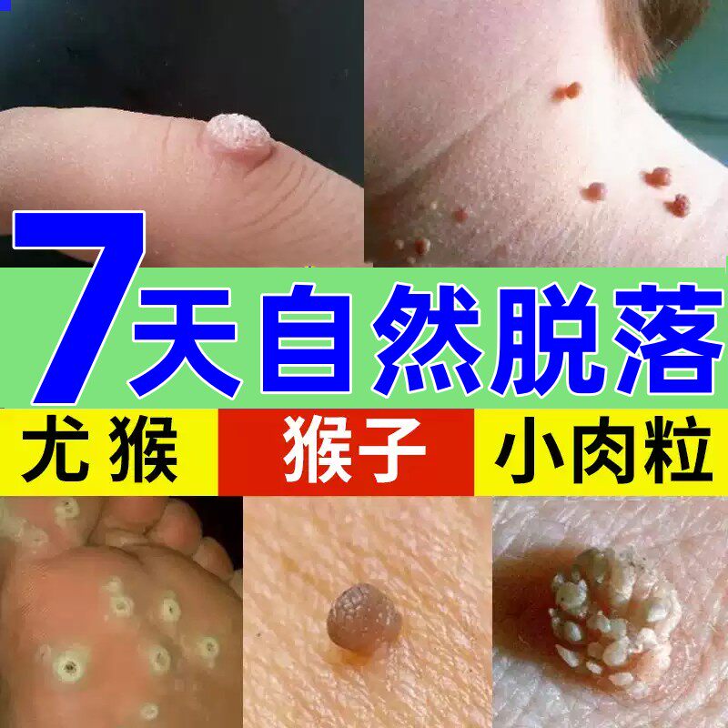 祛皮赘去除膏去上长的小肉粒疙瘩点肉瘤痣神器