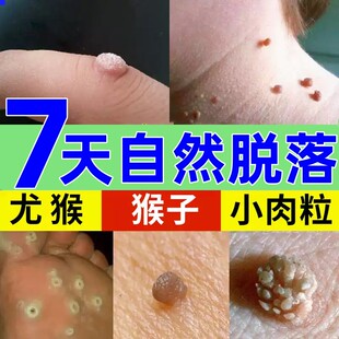 祛皮赘去除膏去上长的小肉粒疙瘩点肉瘤痣神器